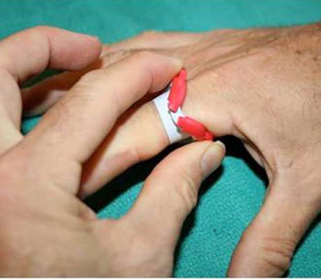 T-Ring device showing the outer ring broken for easier release or application